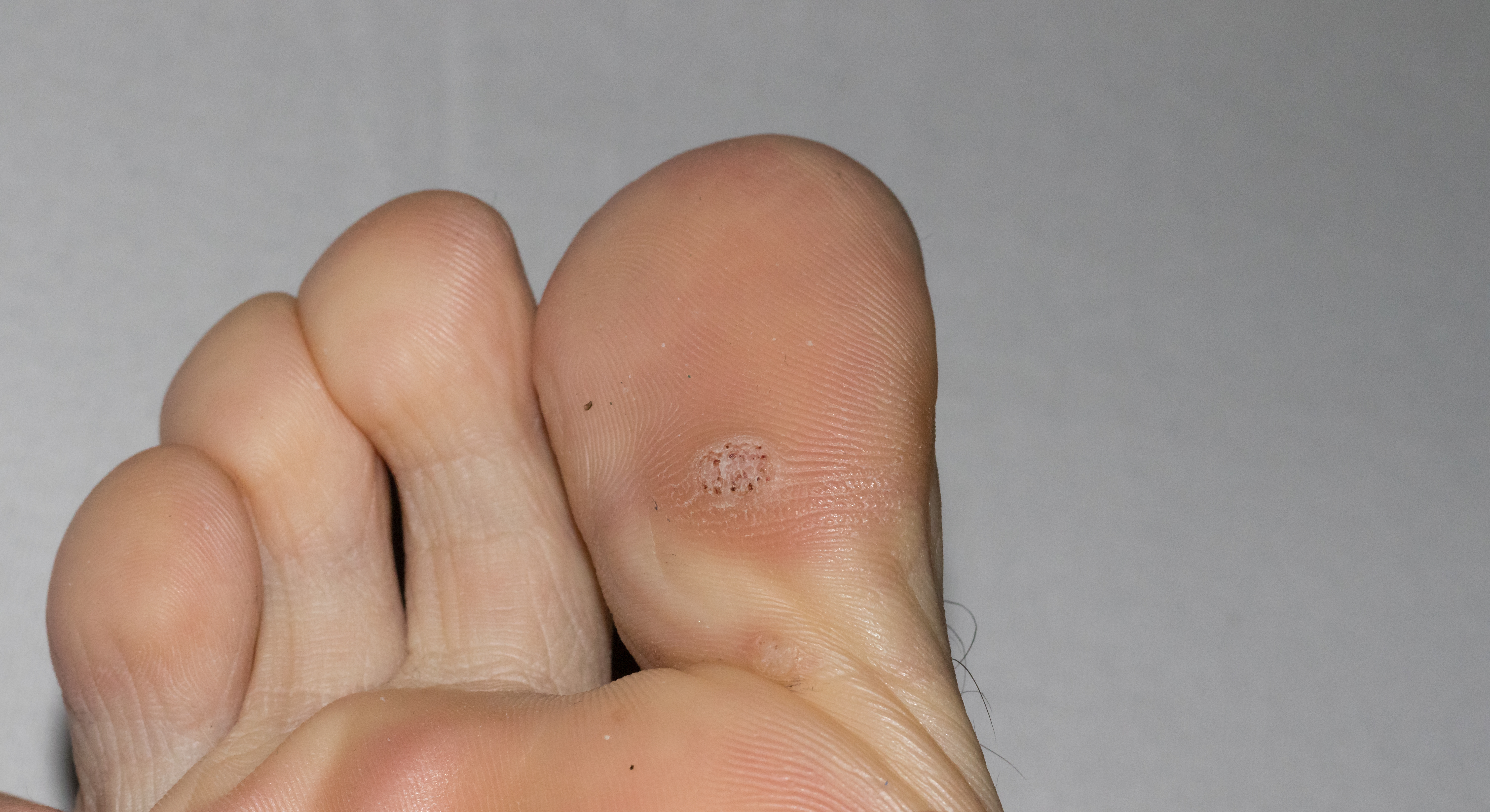 Verrucae treatment